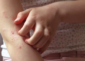 Gejala Jangkitan Cacing pada Kanak-Kanak: Apa yang Perlu Diketahui?