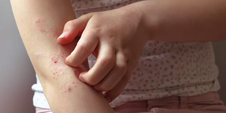 Gejala Jangkitan Cacing pada Kanak-Kanak: Apa yang Perlu Diketahui?