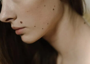 Tahi Lalat dan Sifat Peribadi