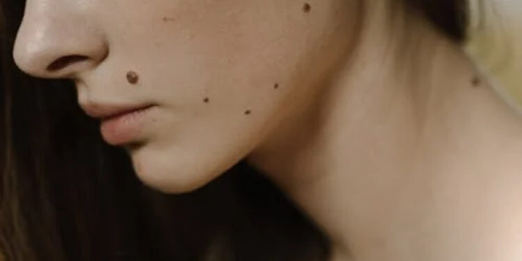 Tahi Lalat dan Sifat Peribadi