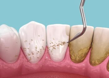 Plak pada Gigi? Ini 8 Cara untuk Menghapuskannya