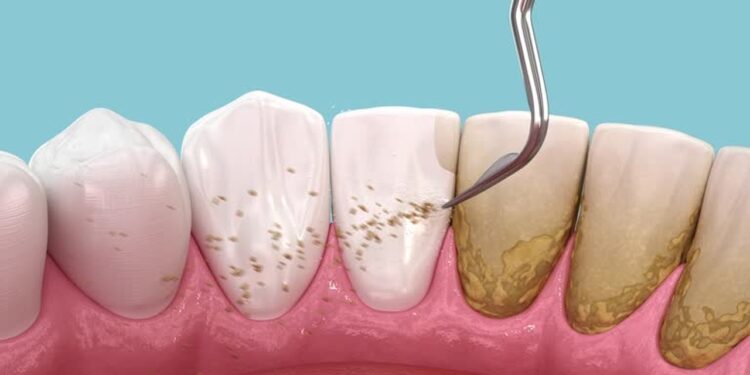 Plak pada Gigi? Ini 8 Cara untuk Menghapuskannya