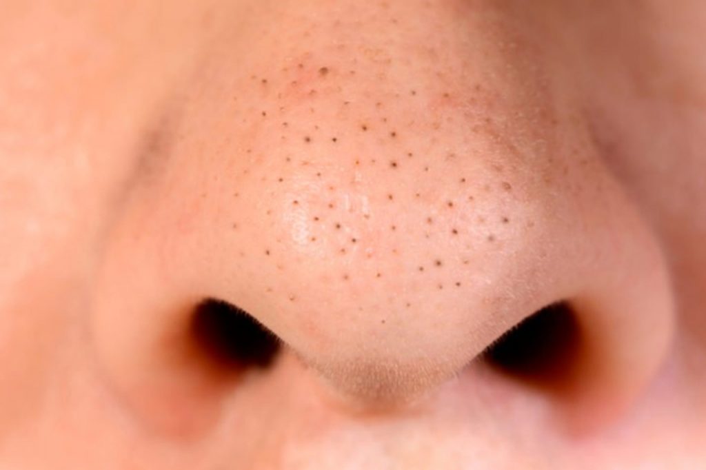 cara mengatasi jerawat blackhead