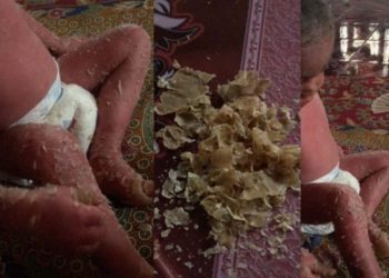 Ibu Pendam Kesedihan, Anak Alami Penyakit ‘Kulit Bersalin’