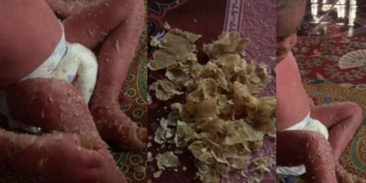 Ibu Pendam Kesedihan, Anak Alami Penyakit ‘Kulit Bersalin’