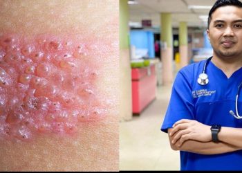 “Siapa Pernah Kena Chickenpox Boleh Dapat Kayap Ular” – Dr Samhan