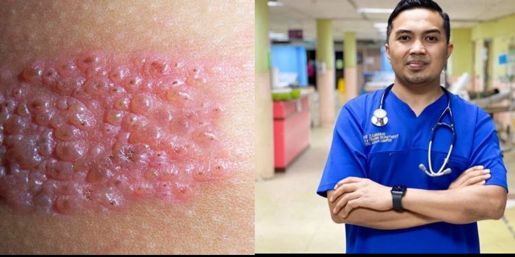 “Siapa Pernah Kena Chickenpox Boleh Dapat Kayap Ular” – Dr Samhan