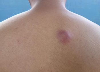 bisul-di-belakang-badan