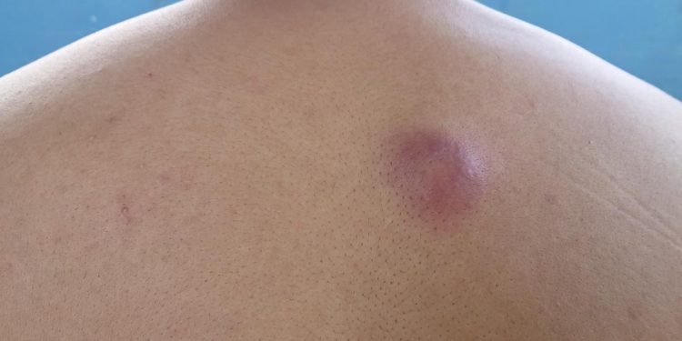 bisul-di-belakang-badan