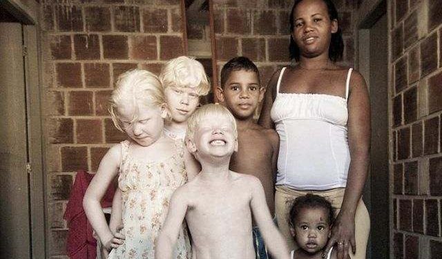 Salah Ibu Atau Ayah Bila Anak Dilahirkan Albino?